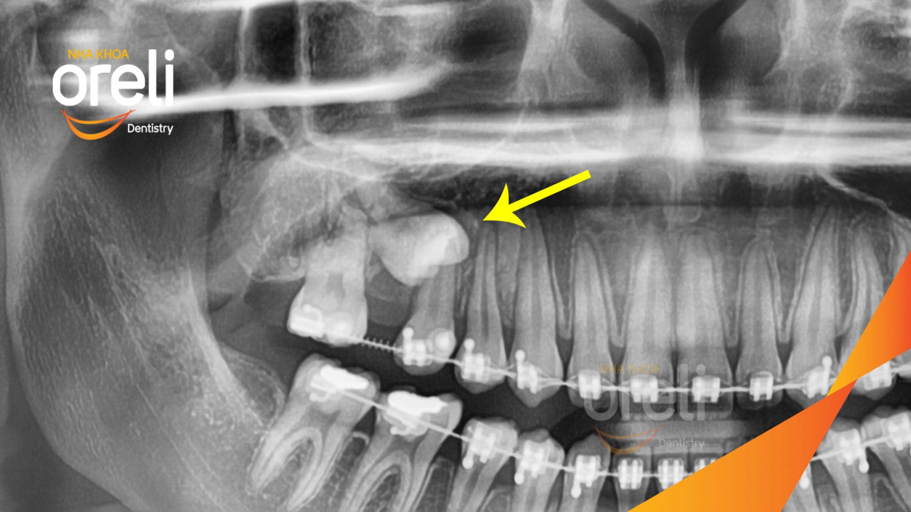 NIỀNG RĂNG KÉO RĂNG 6 LỆCH NGẦM RA ĐÚNG VỊ TRÍ TẠI ORELI - Nha Khoa Oreli