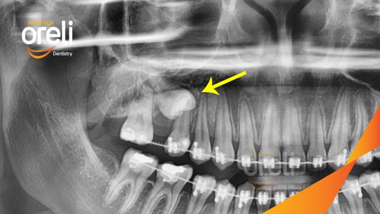 nieng rang oreli bmt bs chung