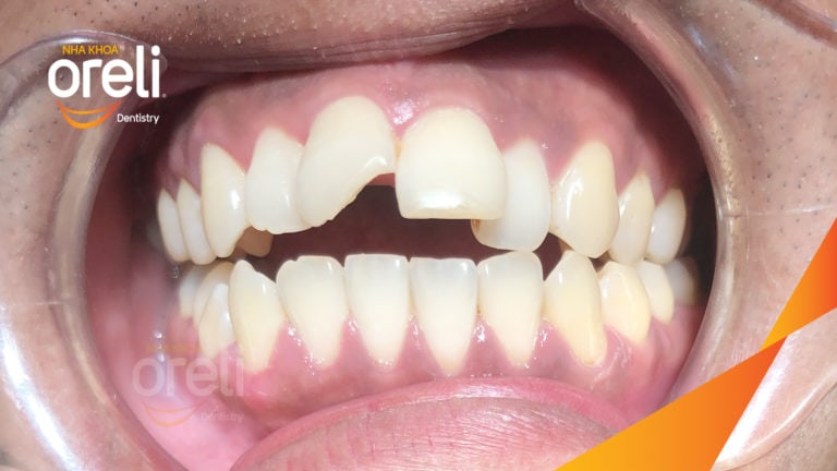 Ca niềng chỉnh cắn hở không nhổ răng kết quả thực tế tại nha khoa Oreli