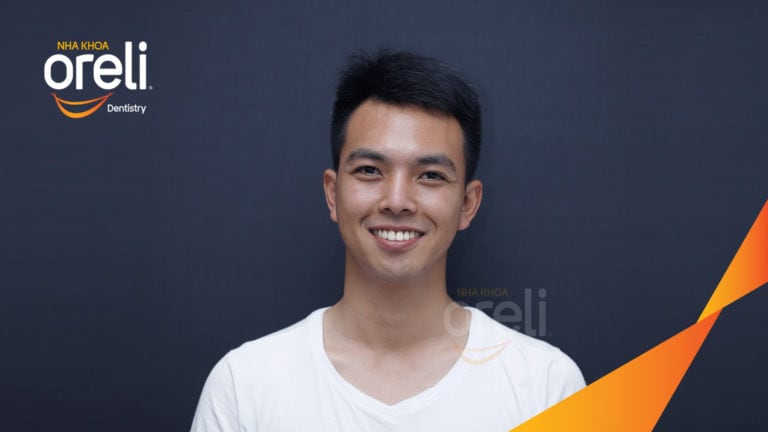 Ca niềng chỉnh cắn hở không nhổ răng kết quả thực tế tại nha khoa Oreli
