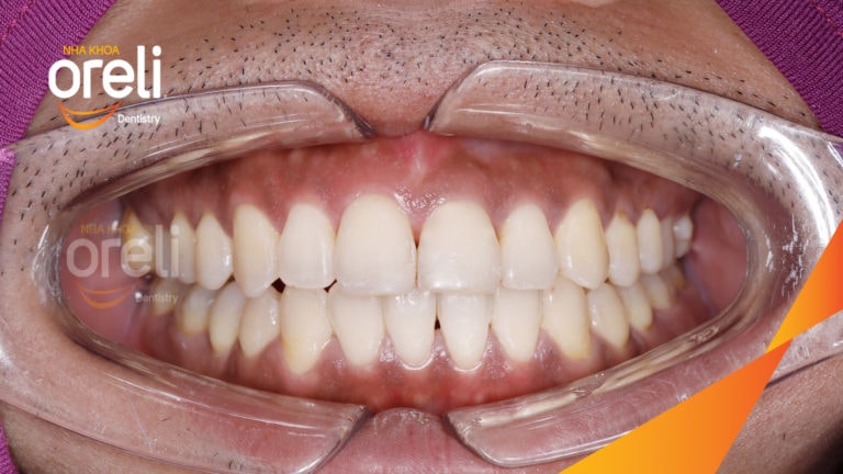 Ca niềng chỉnh cắn hở không nhổ răng kết quả thực tế tại nha khoa Oreli