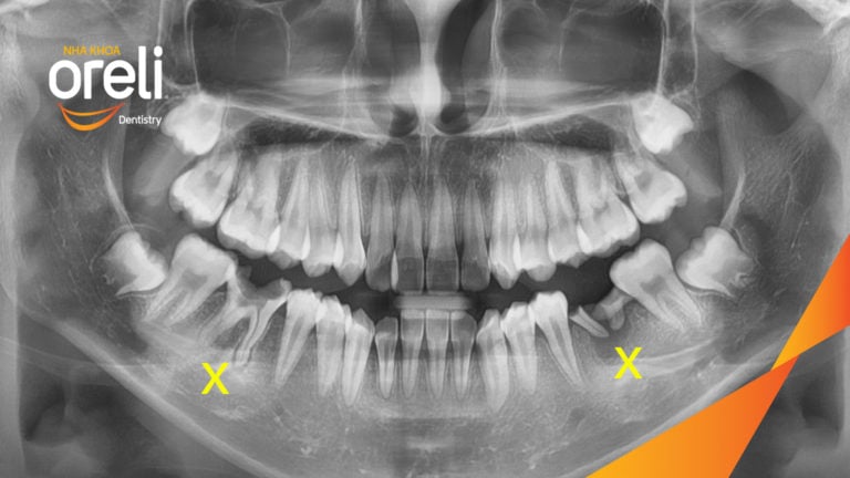 Ca niềng chỉnh hô nhổ 2 răng 4 hàm trên di gần răng 7 8 hàm dưới cho nụ cười đẹp – Kết quả sau hơn 2 năm ở Oreli