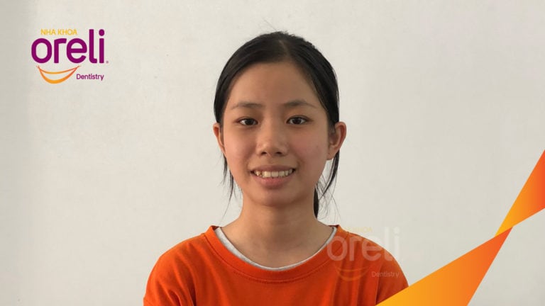 Ca niềng chỉnh hô nhổ 2 răng 4 hàm trên di gần răng 7 8 hàm dưới cho nụ cười đẹp – Kết quả sau hơn 2 năm ở Oreli