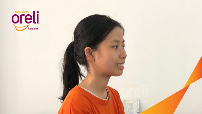 Ca niềng chỉnh hô nhổ 2 răng 4 hàm trên di gần răng 7 8 hàm dưới cho nụ cười đẹp – Kết quả sau hơn 2 năm ở Oreli