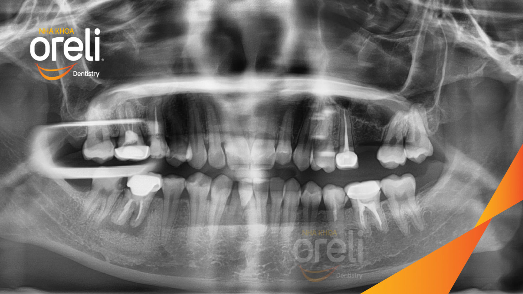 Ca niềng hạng 3 móm di gần răng 78 cho nụ cười đẹp ở Oreli