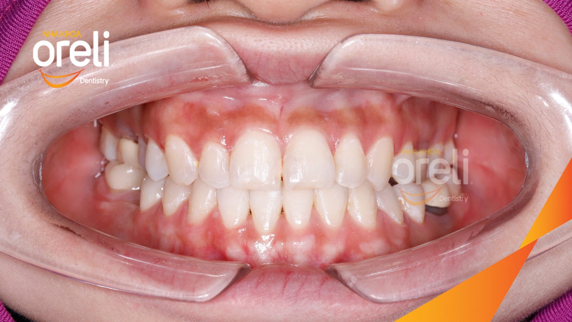 Ca niềng hạng 3 móm di gần răng 78 cho nụ cười đẹp ở Oreli