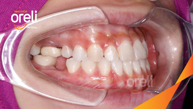 Ca niềng hạng 3 móm di gần răng 78 cho nụ cười đẹp ở Oreli