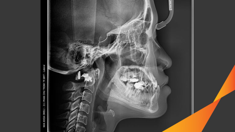 Ca niềng hạng 3 móm di gần răng 78 cho nụ cười đẹp ở Oreli