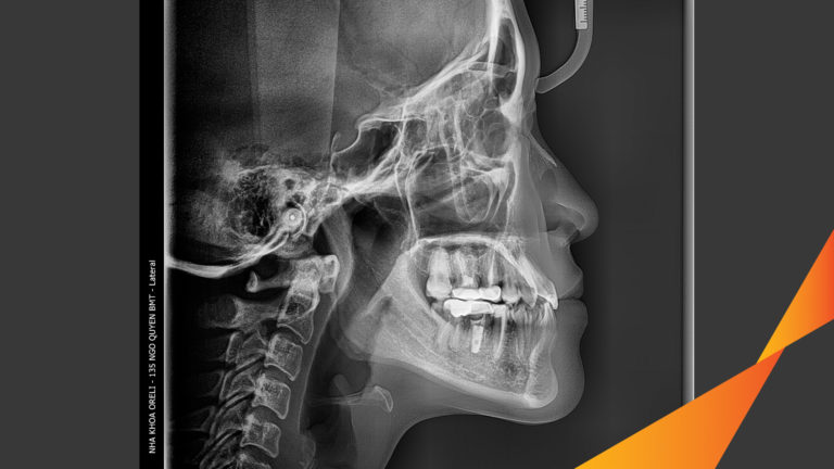 Ca niềng hạng 3 móm di gần răng 78 cho nụ cười đẹp ở Oreli