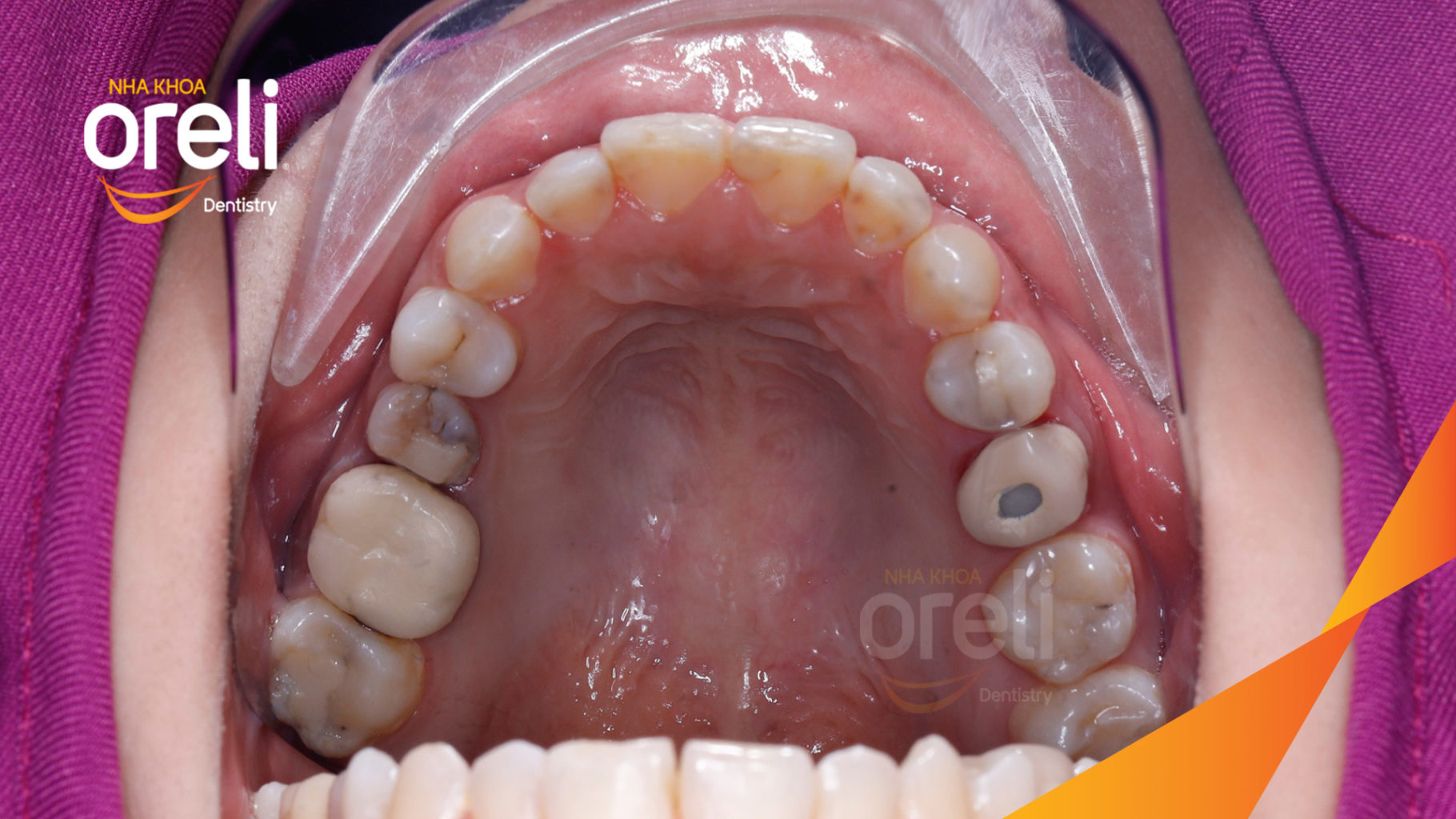 Kết quả đạt được sau  -  tại Oreli