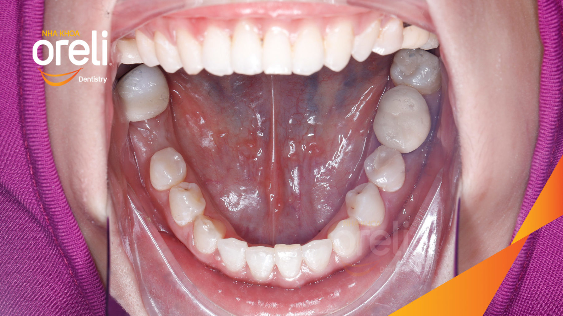  trước khi điều trị tại Oreli