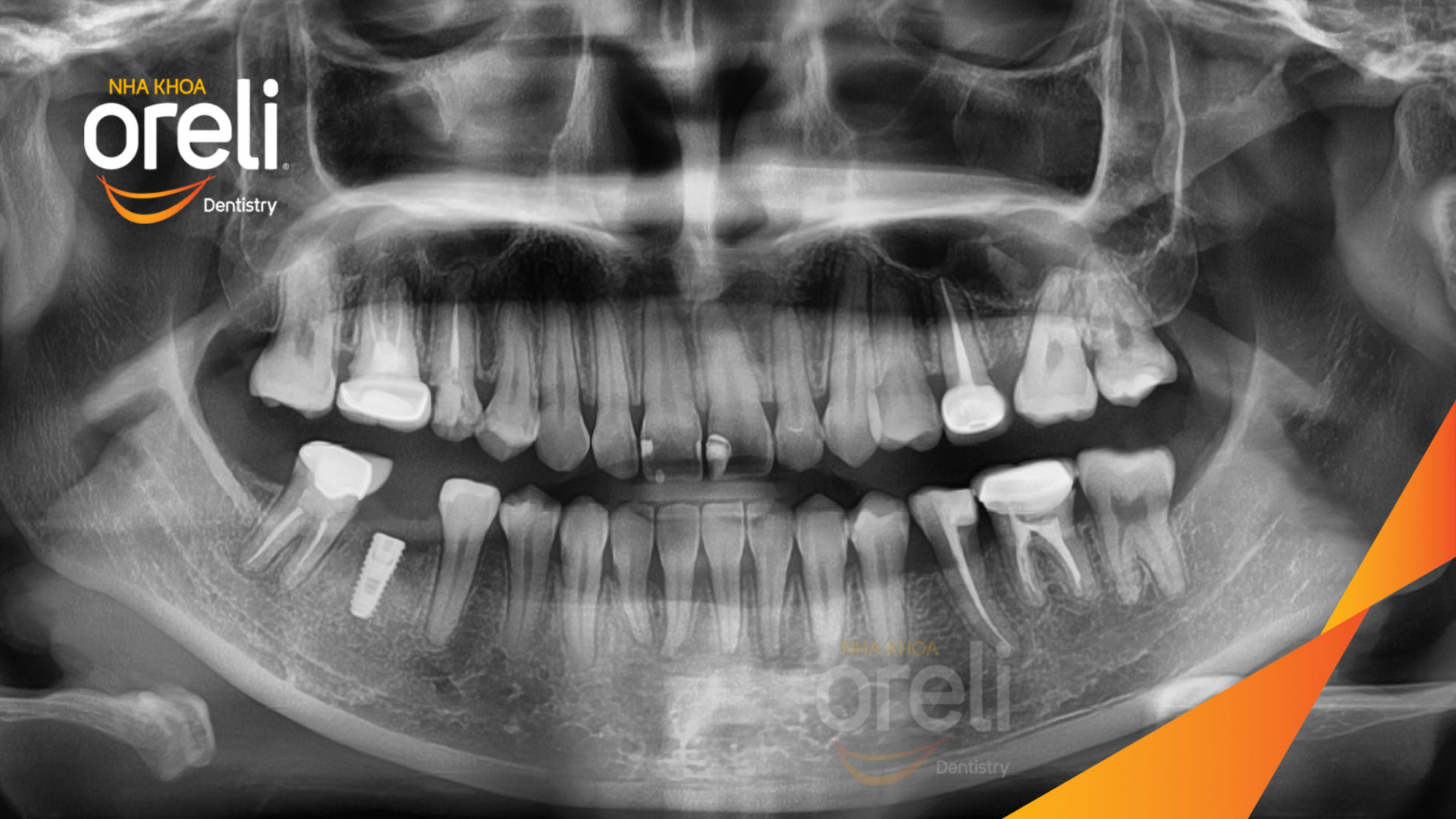 Ca niềng hạng 3 móm di gần răng 78 cho nụ cười đẹp ở Oreli