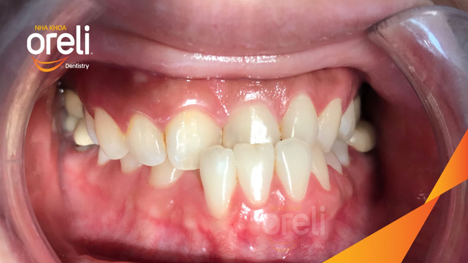 Ca niềng hạng 3 móm di gần răng 78 cho nụ cười đẹp ở Oreli