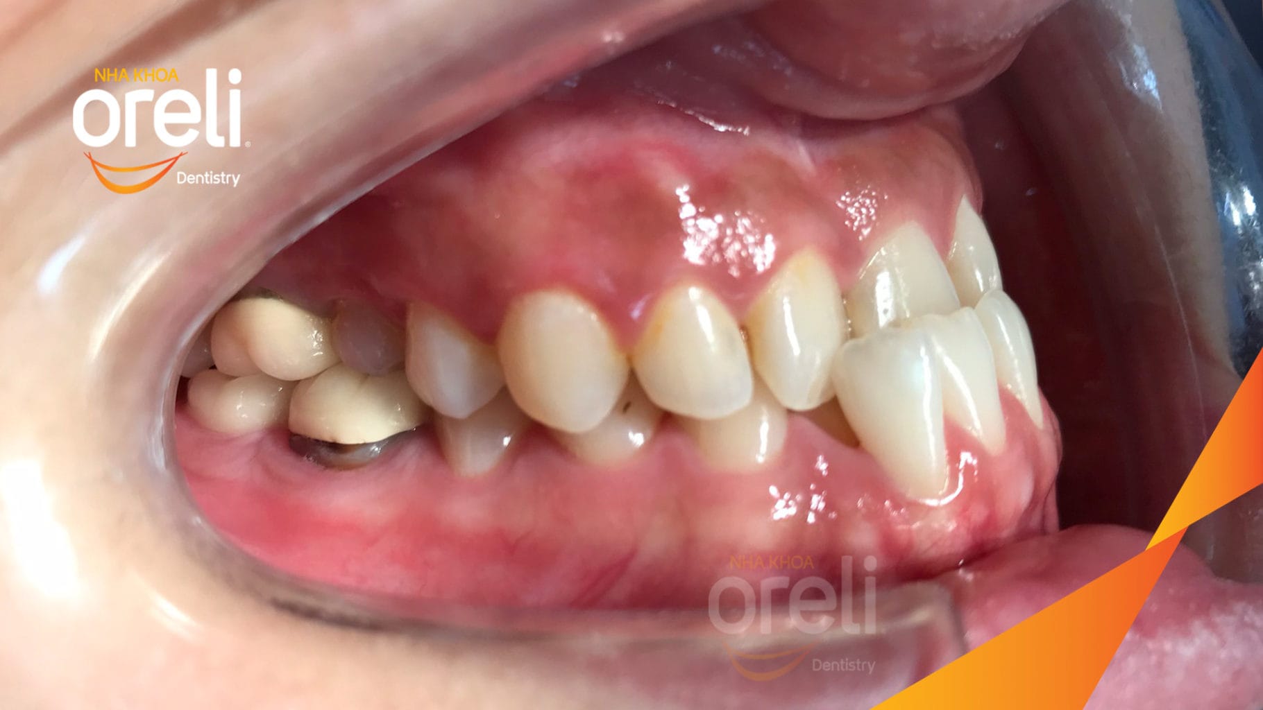 Ca niềng hạng 3 móm di gần răng 78 cho nụ cười đẹp ở Oreli