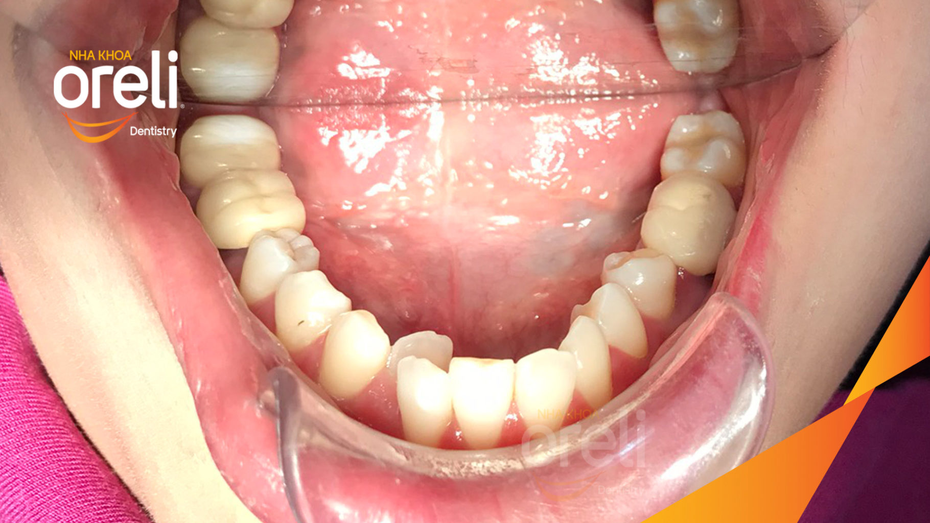 Trước điều trị:  tại Oreli