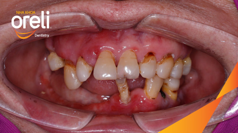Trồng răng hai hàm người lớn tuổi được không? – Kết quả tại Oreli
