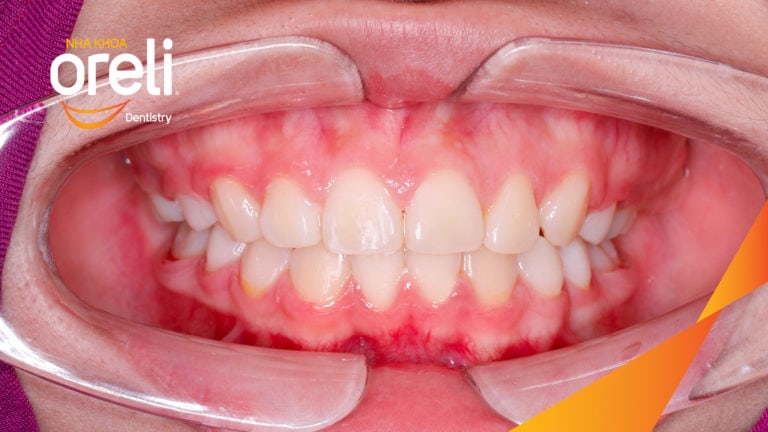 Niềng răng hô nhổ 2 răng số 4 hàm trên trường hợp 2 răng cửa hàm dưới? Case thực tế tại Oreli