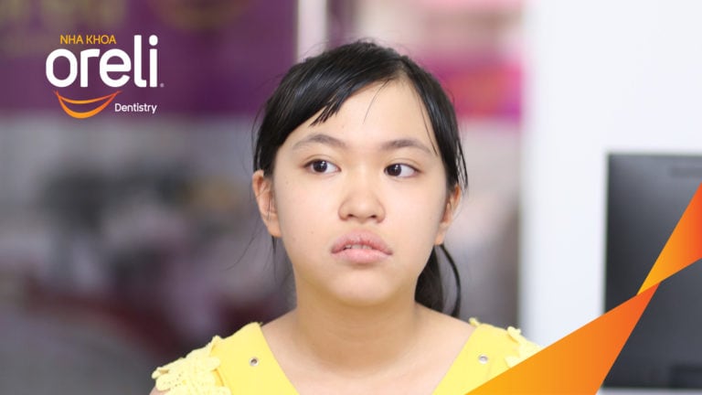 Niềng răng hô nhổ 2 răng số 4 hàm trên trường hợp 2 răng cửa hàm dưới? Case thực tế tại Oreli