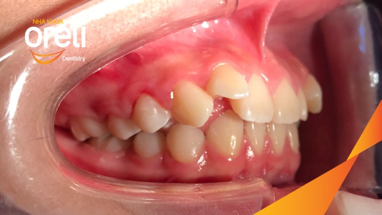 Niềng răng hô nhổ 2 răng số 4 hàm trên trường hợp 2 răng cửa hàm dưới? Case thực tế tại Oreli