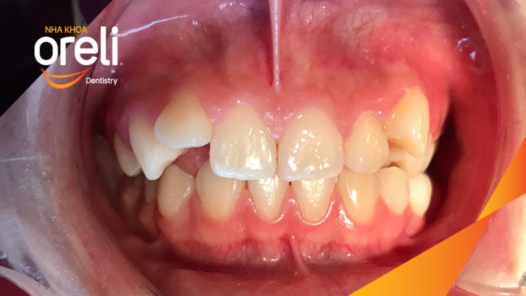 Niềng răng hô nhổ 2 răng số 4 hàm trên trường hợp 2 răng cửa hàm dưới? Case thực tế tại Oreli