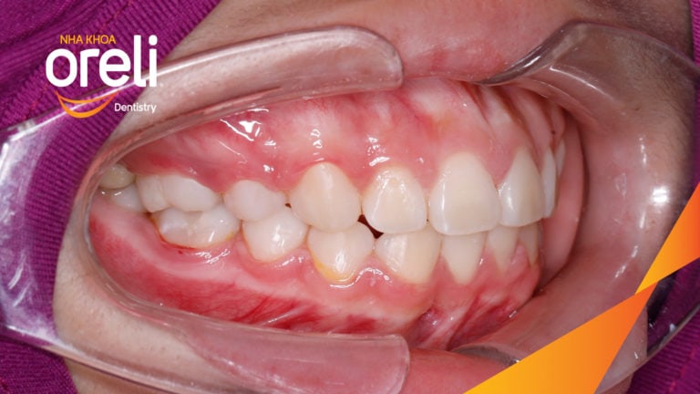 Niềng răng hô nhổ 2 răng số 4 hàm trên trường hợp 2 răng cửa hàm dưới? Case thực tế tại Oreli