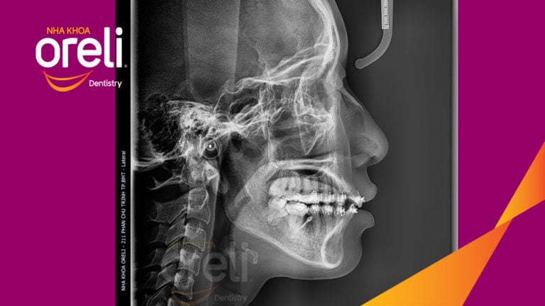 Tháo mắc cài ca chỉnh nha lại tiếp tục đóng khoảng chỉnh hô tại Oreli