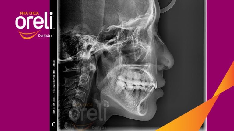 Tháo mắc cài ca chỉnh nha lại tiếp tục đóng khoảng chỉnh hô tại Oreli