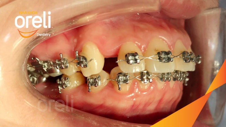 Tháo mắc cài ca chỉnh nha lại tiếp tục đóng khoảng chỉnh hô tại Oreli