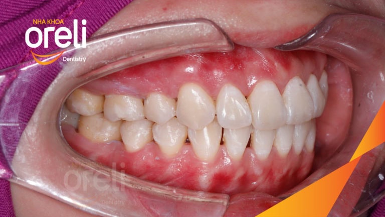 Tháo mắc cài ca chỉnh nha lại tiếp tục đóng khoảng chỉnh hô tại Oreli