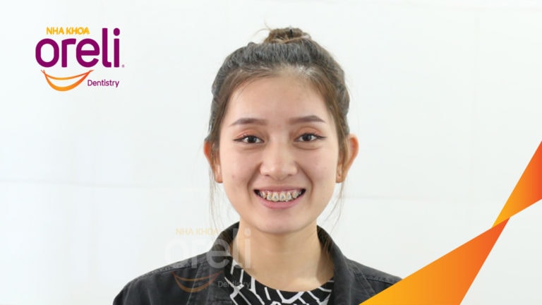 Tháo mắc cài ca chỉnh nha lại tiếp tục đóng khoảng chỉnh hô tại Oreli