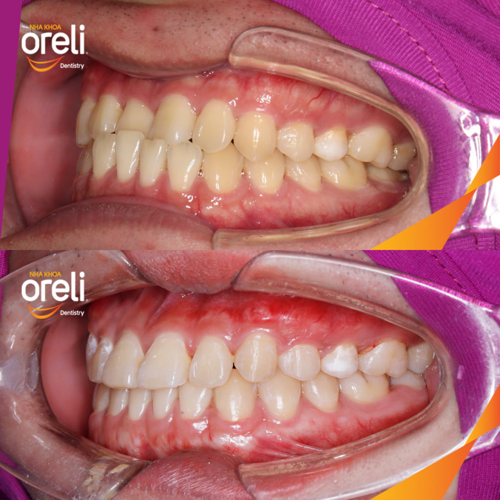 Kết quả đạt được sau  -  tại Oreli