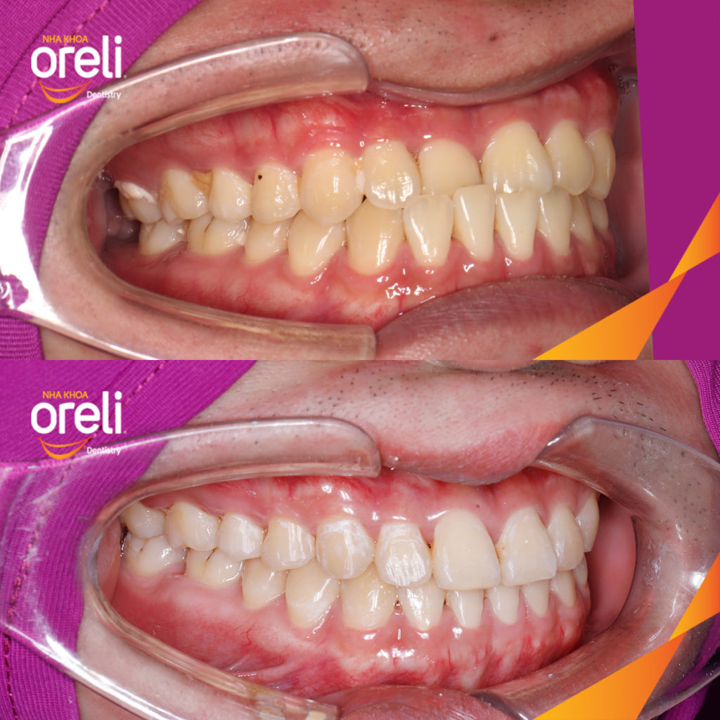 Kết quả sau :  tại Oreli