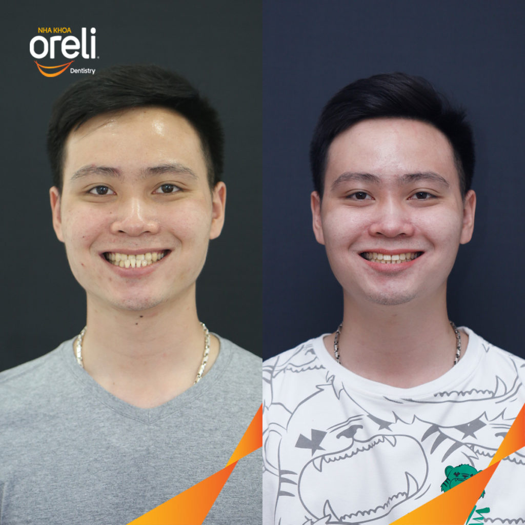Quá trình  trong  tại Oreli