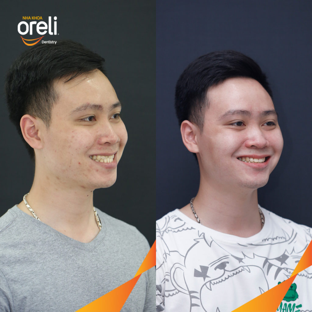  trước khi điều trị tại Oreli