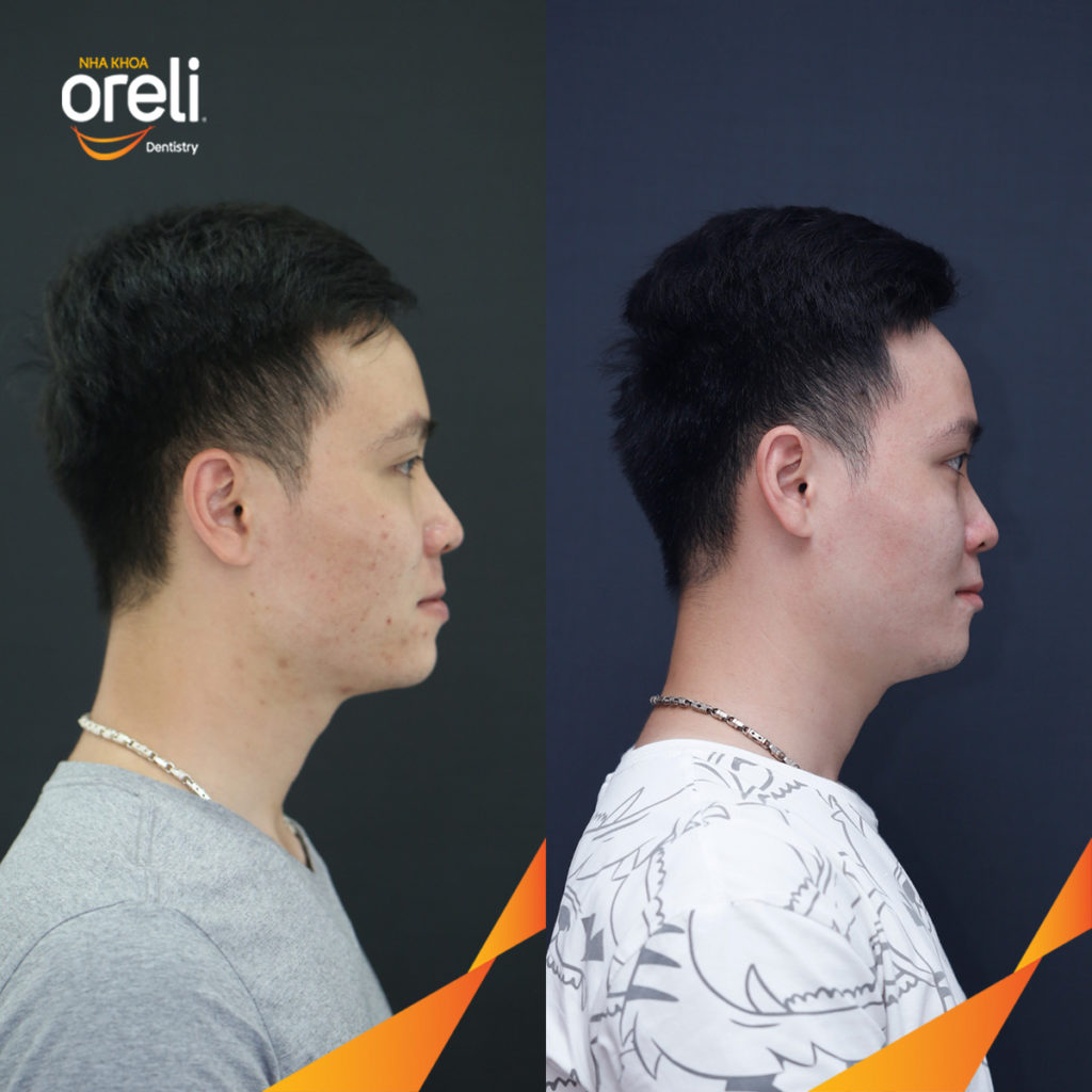 Trước điều trị:  tại Oreli