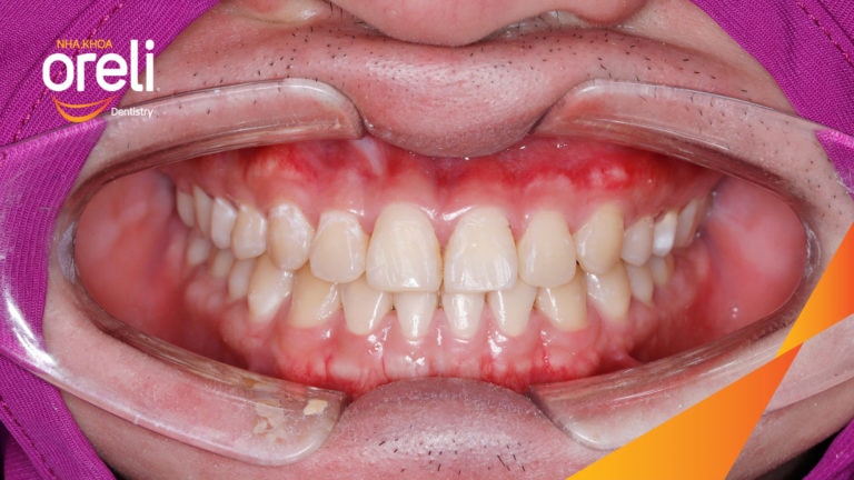 Ca chỉnh móm hạng 3 nặng – Thay đổi rõ rệt sau niềng răng tại Oreli