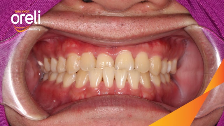 Ca chỉnh móm hạng 3 nặng – Thay đổi rõ rệt sau niềng răng tại Oreli