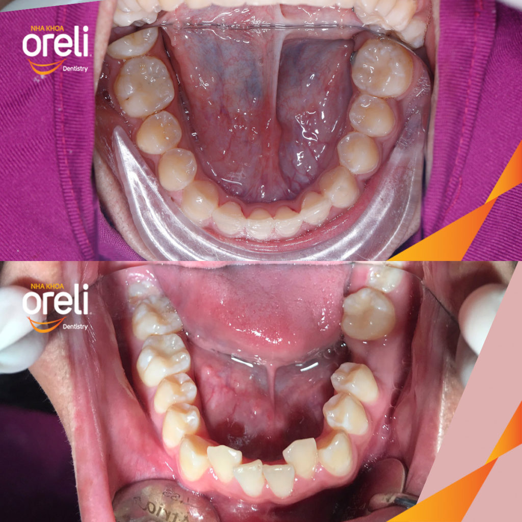 Kết quả đạt được sau  -  tại Oreli