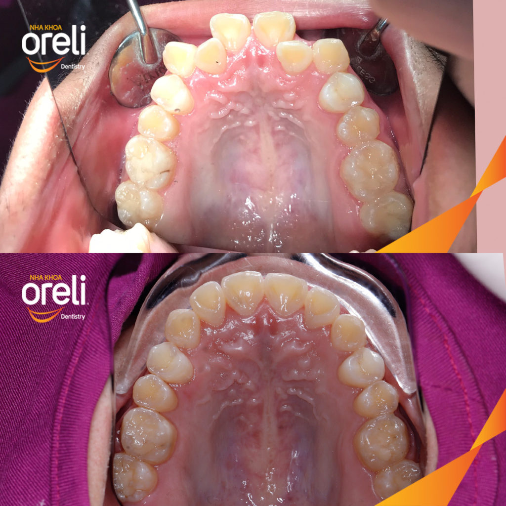 Kết quả sau :  tại Oreli