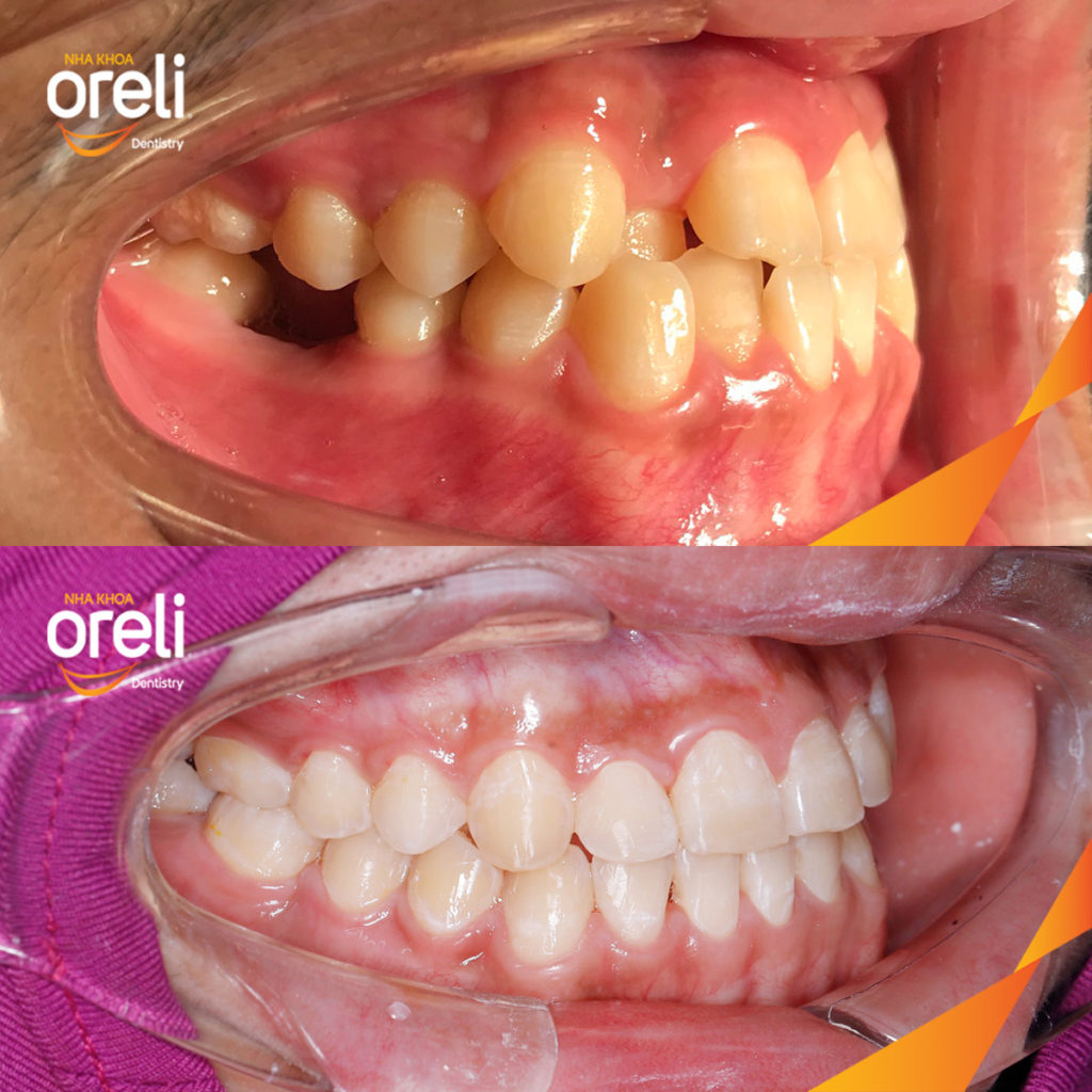 Quá trình  trong  tại Oreli