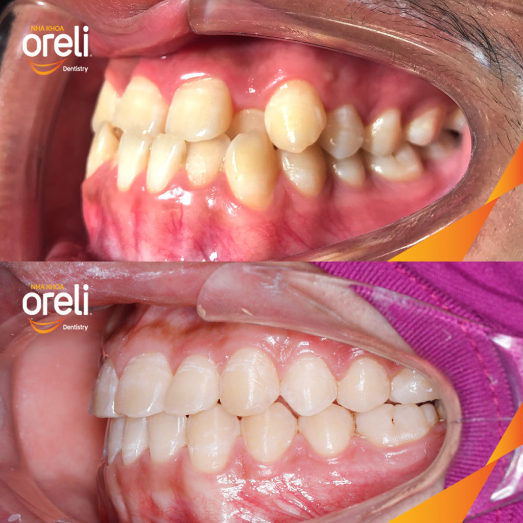 Thực hiện  kéo dài  tại Oreli