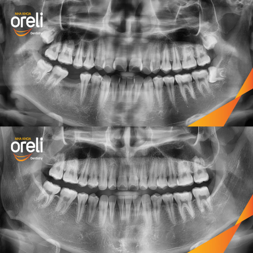 Trước điều trị:  tại Oreli