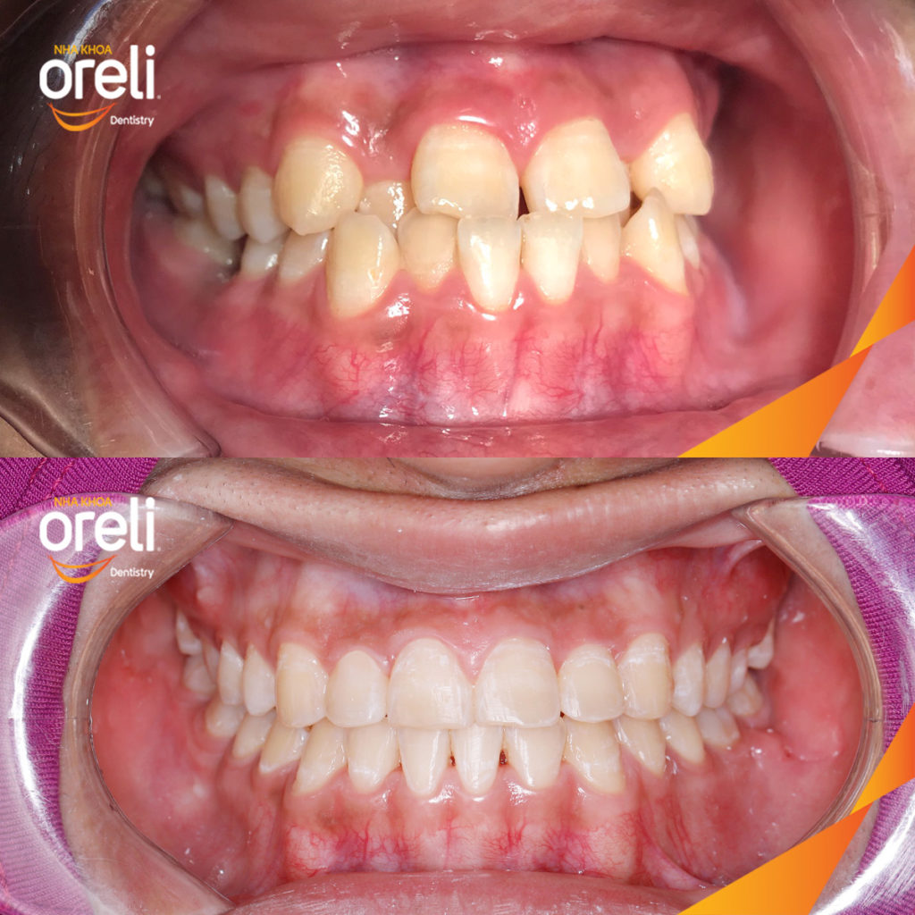  trước khi điều trị tại Oreli