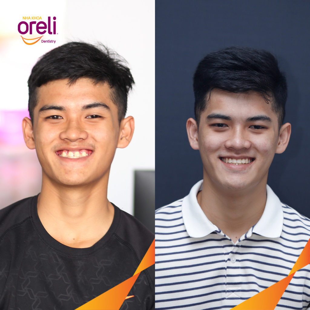 Trước điều trị:  tại Oreli
