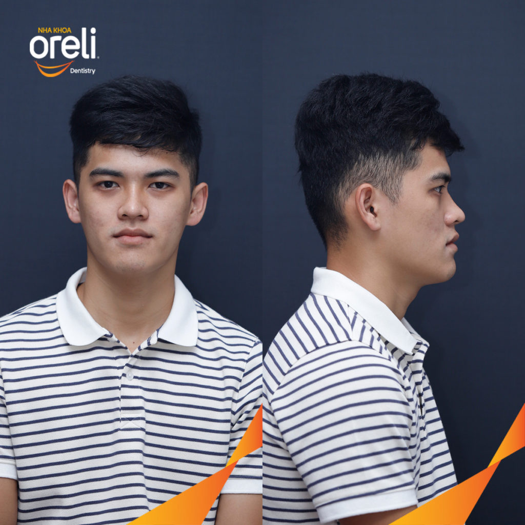  trước khi điều trị tại Oreli