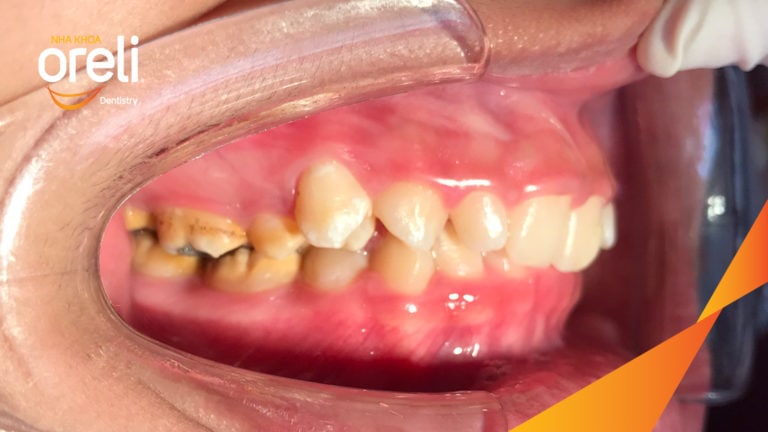 Ca niềng chỉnh cắn sâu nặng kèm cắn chéo vùng răng sau kết quả thực tế tại nha khoa Oreli