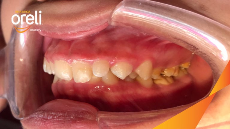 Ca niềng chỉnh cắn sâu nặng kèm cắn chéo vùng răng sau kết quả thực tế tại nha khoa Oreli