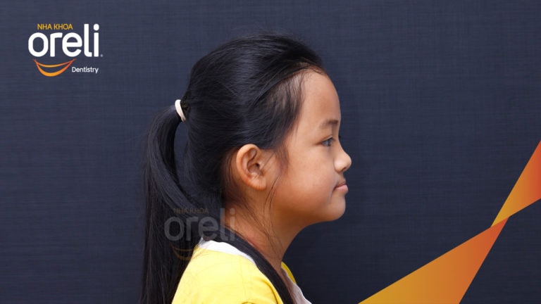 Niềng chỉnh cắn ngược lúc 9 tuổi lúc chưa mọc đủ răng ở nha khoa Oreli