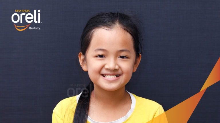 Niềng chỉnh cắn ngược lúc 9 tuổi lúc chưa mọc đủ răng ở nha khoa Oreli