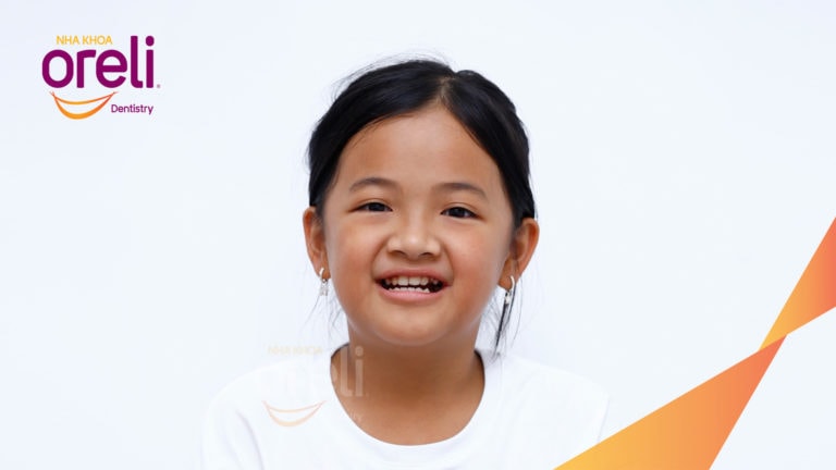 Niềng chỉnh cắn ngược lúc 9 tuổi lúc chưa mọc đủ răng ở nha khoa Oreli